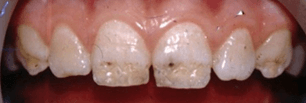 Плохое состояние своих зубов